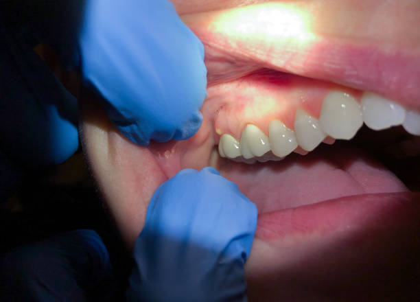 Best Emergency Dental Care for Broken or Chipped Teeth in Reinholds, PA