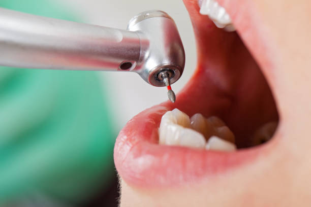 Best Emergency Dental Care for Broken or Chipped Teeth in Reinholds, PA